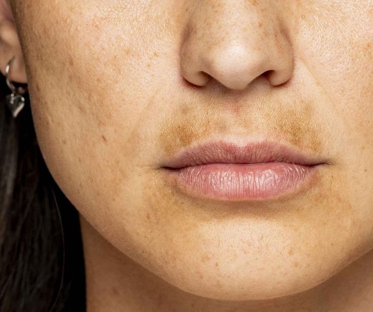 melasma