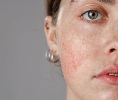 rosacea